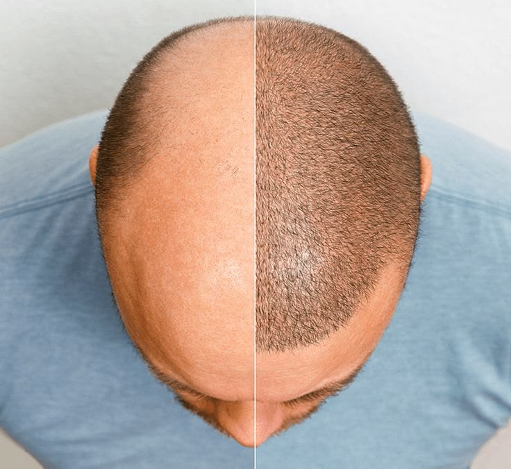 Hair Transplantation (Big FUE)